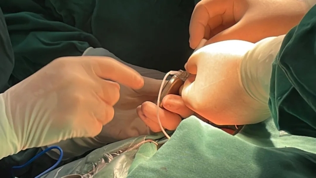 据陈鸿耀主任介绍，迷走神经刺激术是一种“体内植入式电子疗法”，通过微创手术，不需要开颅，只需在颈部和锁骨下方开出2-4厘米长的小切口，将电极缠在迷走神经上，随后在下方胸口处植入脉冲发生器，缝合即可完成手术，手术创伤小、安全性高、疗效显著，患者的接受度比较高。